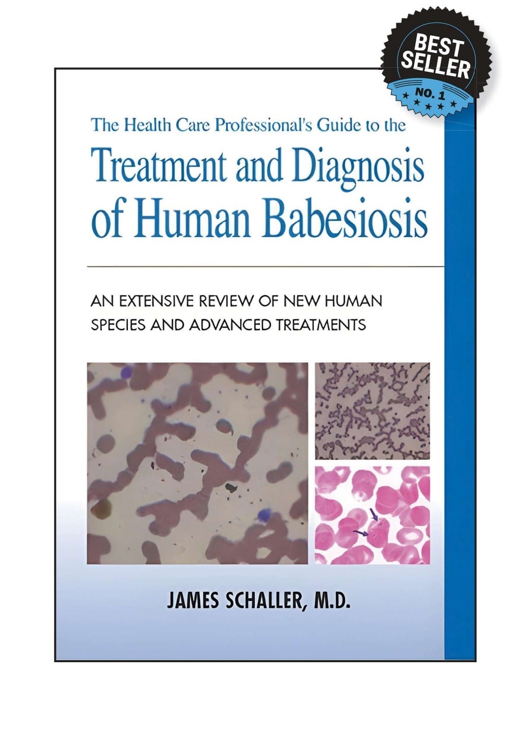babesiosis