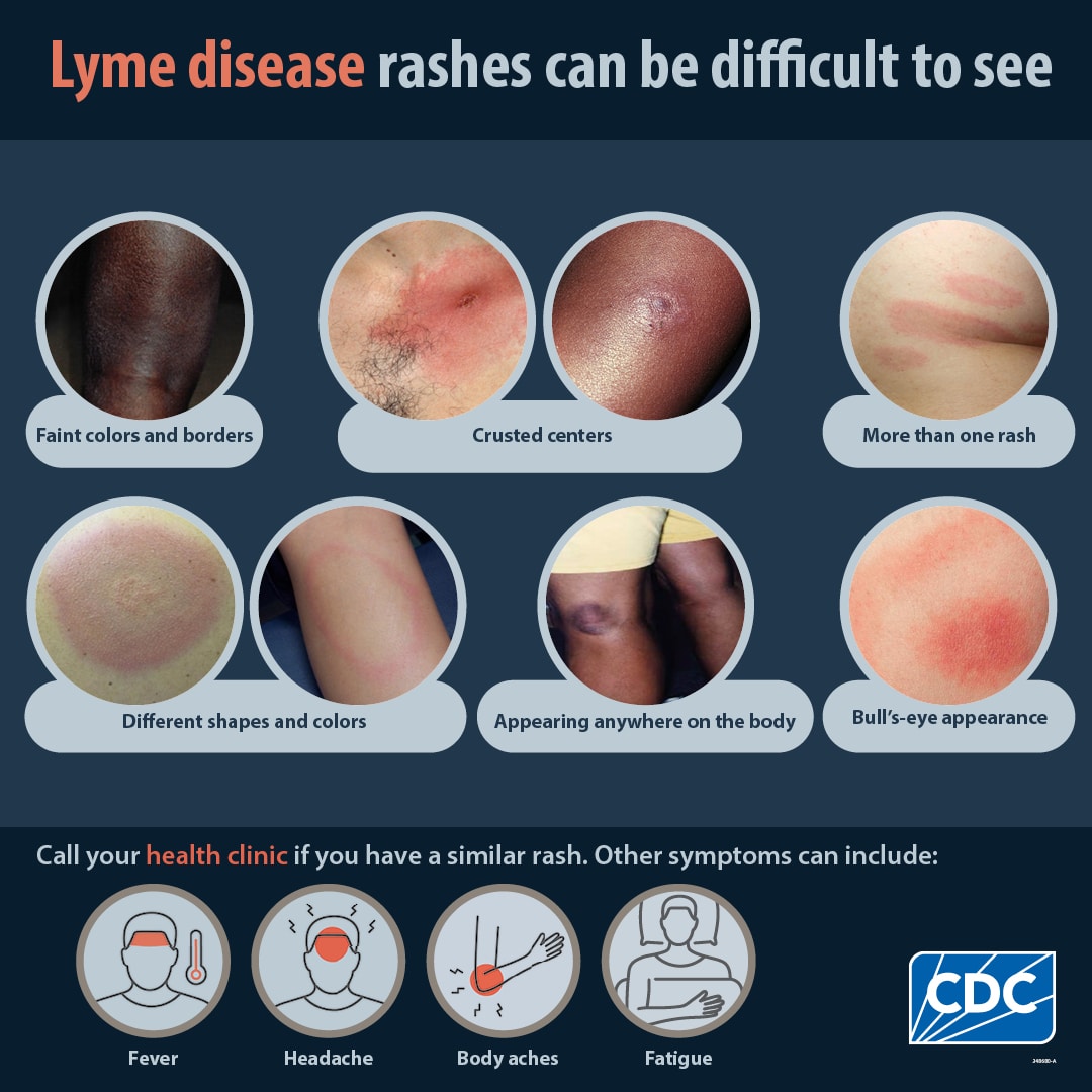 Whelp Rash Lyme disease prolific doctor author on rashes from over 32 years ...
