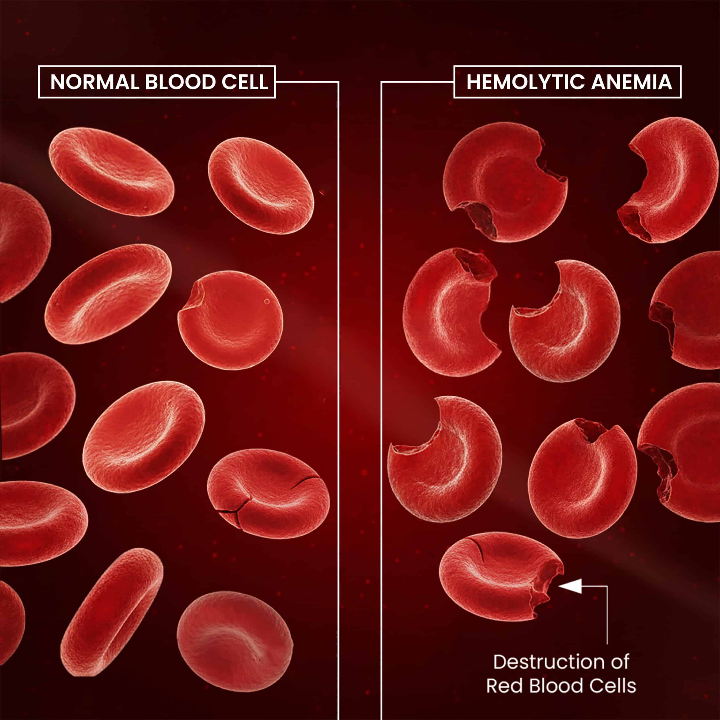 hemolytic anemia 1 (1)