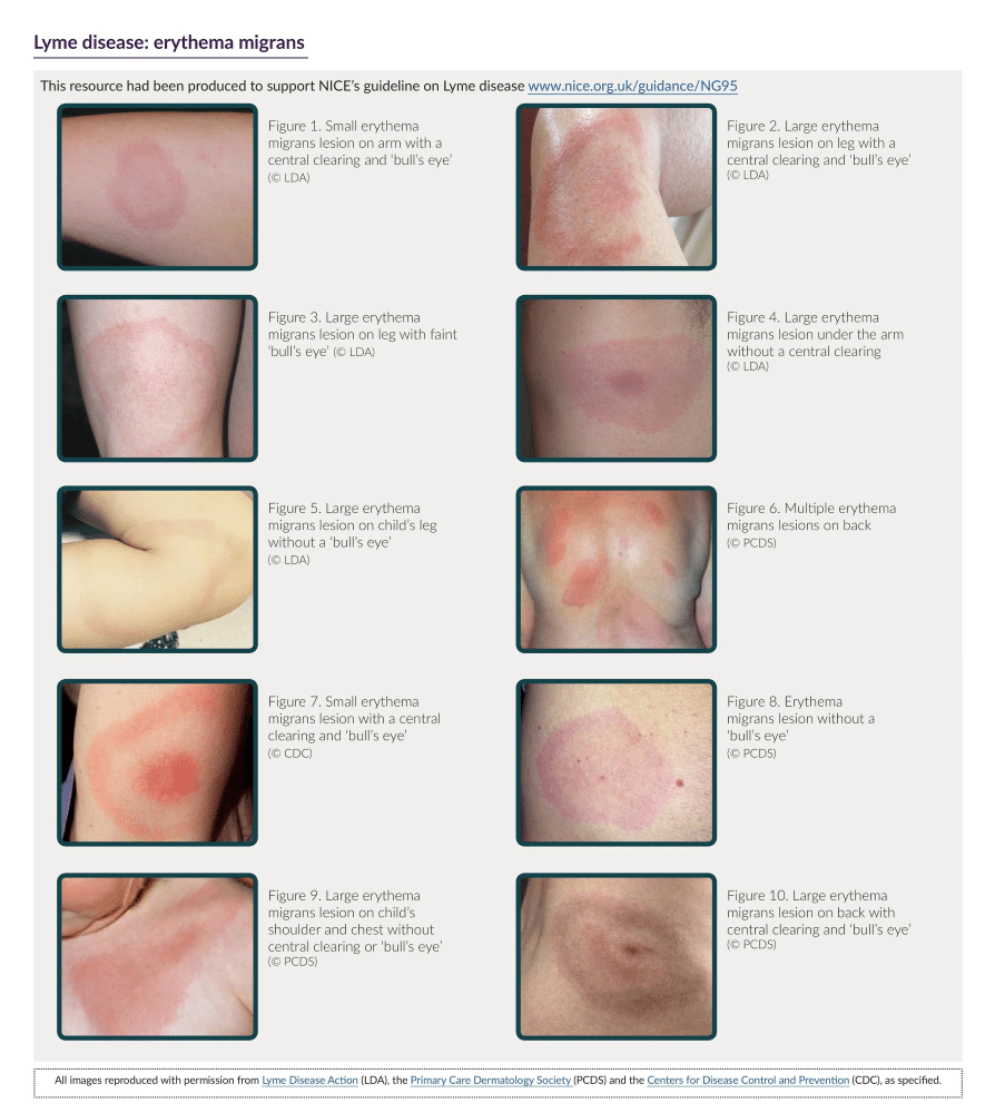 lyme disease rash images